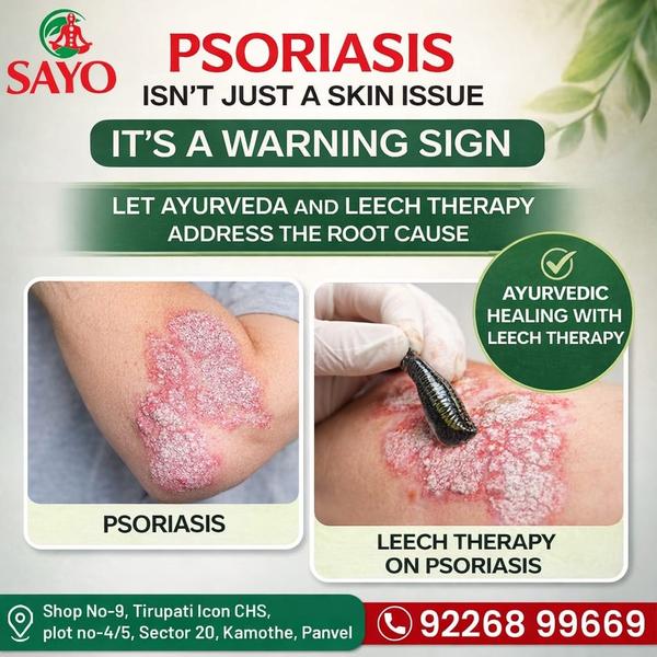 Psoriasis Isn't Just a Skin Issue, It's a Warning Sign